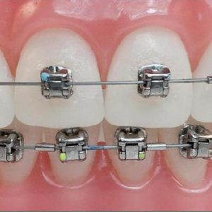 Ortodontia com Aparelhos Autoligados